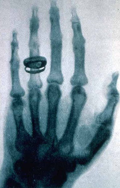 Zdjęcie dłoni Rudolfa Kollikera wykonane przez Röntgena na posiedzeniu Physical Medical Society w Würzburgu 23 stycznia 1896